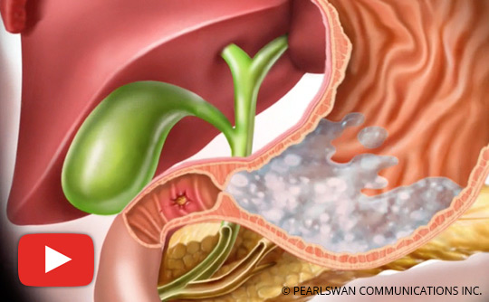 What You Should Know About Duodenal Ulcer