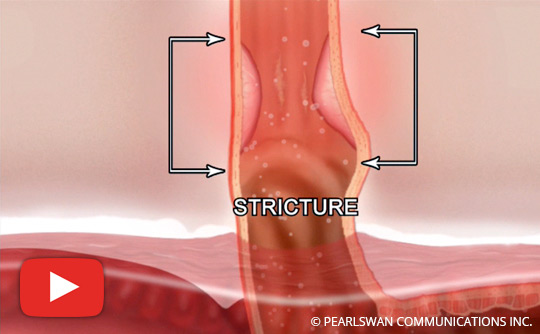 What You Should Know About Esophageal Stricture