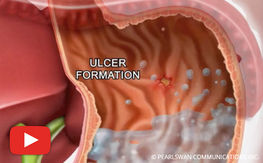 What You Should Know About Gastric Ulcer