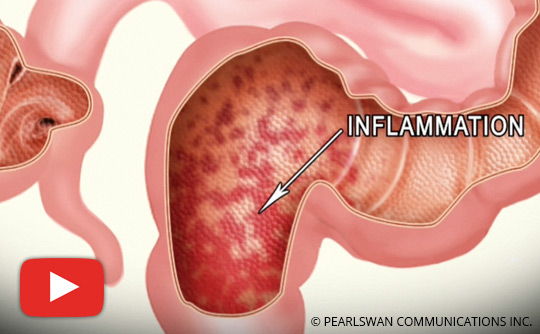What You Should Know About Ulcerative Colitis